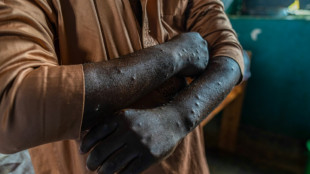 RDC: la vaccination contre le mpox commence samedi &agrave; Goma